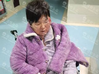 2533   丁*娥脑出血、肋骨骨折求助