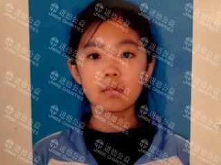 26002  11岁女孩孙*迪罕见病ANCA相关性血管炎求助